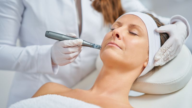 The Ultimate Guide to Microneedling: Benefits, Procedure, and Aftercare